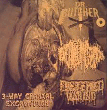 Hydropneumothorax : 3-Way Cranial Excavation